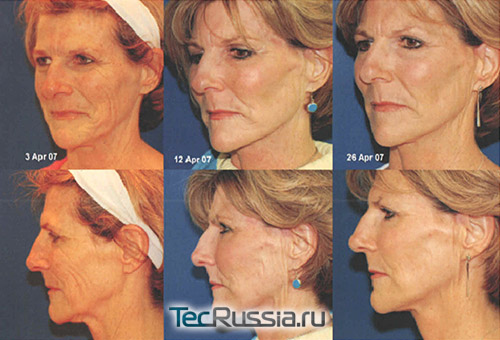 Фото до и после омоложения кожи лица на аппарате «PlasmaJet Derma»