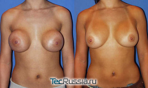 до и после замены грудных имплантов