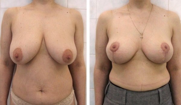 Шрамы после подтяжки груди