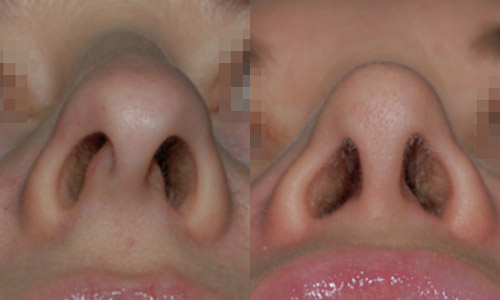 фото до и после пластики носа (хирург – В.С.Григорянц), вид снизу