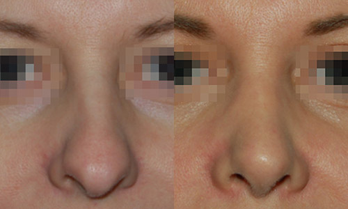 фото до и после пластики носа (хирург – В.С.Григорянц), вид спереди