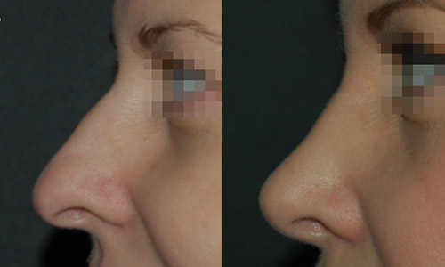 фото до и после пластики носа (хирург – В.С.Григорянц), профиль
