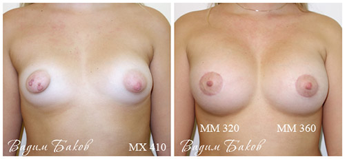 фото до и после увеличеия тубулярной груди