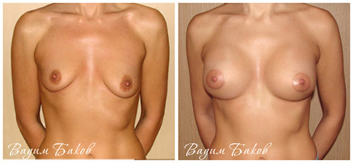 фото до и после увеличения асимметричной груди