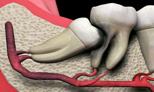 Разрушение корня зуба мудрости