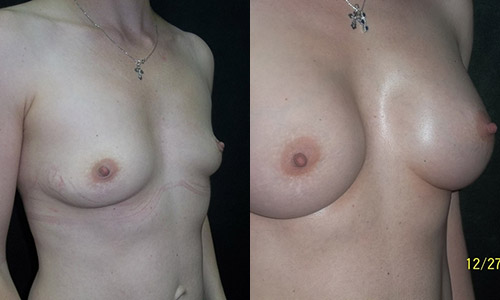 пациентка 1 до и после пластики груди, вид сбоку, хирург Алексанян Тигран Альбертович
