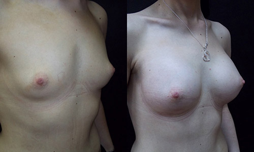 пациентка 3 до и после пластики груди, вид сбоку, хирург Алексанян Тигран Альбертович