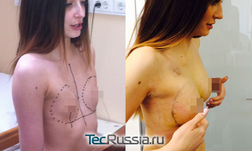 Кристина Дерябина до и после увеличения груди