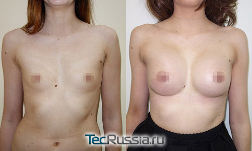 Кристина Дерябина до и после пластической операции