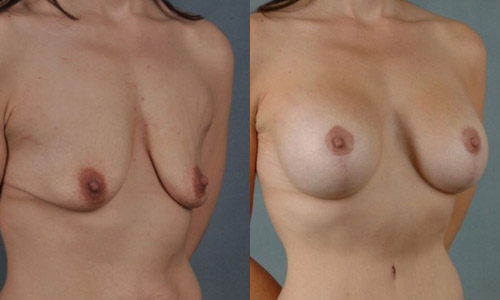 Фото до и после пластики обвисшей груди (подтяжка и увеличение)