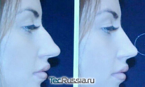 Моделирование носа Берниковой перед ринопластикой