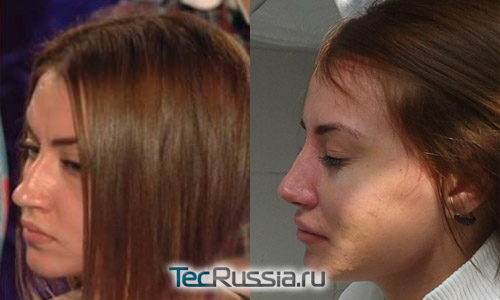 Виктория Берникова до и после ринопластики (пластики носа)