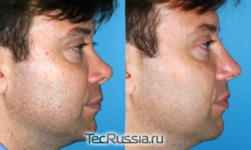 фото до и после вторичной ринопластики, профиль