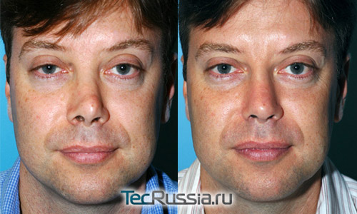 фото до и после вторичной ринопластики, анфас