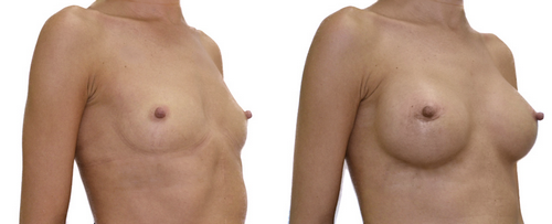 Фото «До» и «После» увеличения груди пациентки с пересаженной печенью. Хирург- Файзуллин Т.Р.