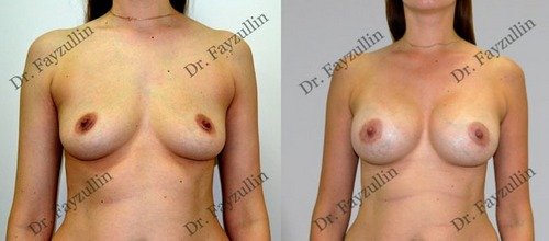 Фото «До и После» увеличительной маммопластики. Хирург Т.Р.Файзуллин.