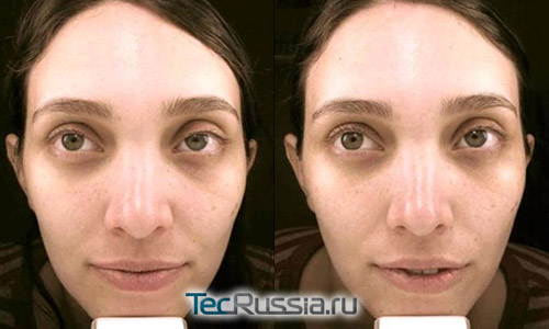 фото до и после газожидкостного пилинга лица
