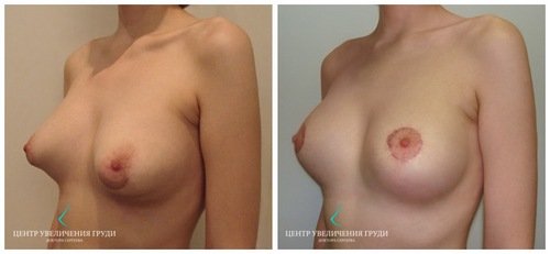 тубулярная грудь: до и после пластики