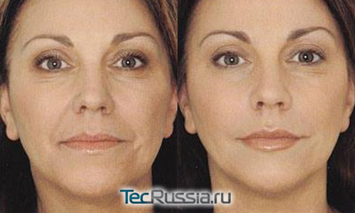 фото до и после мезолифтинга лица