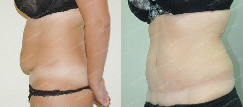 абдоминопластика после родов – фото до и после