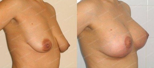 результаты пластики груди после родов