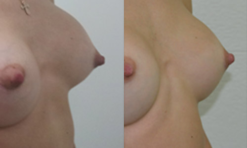 Состояние груди до и после коррекции капсулярной контрактуры