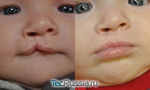 ребенок с односторонним расщеплением губы – фото до и после операции