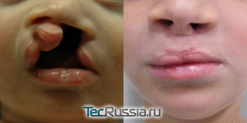 фото до и после операции по удалению заячьей губы
