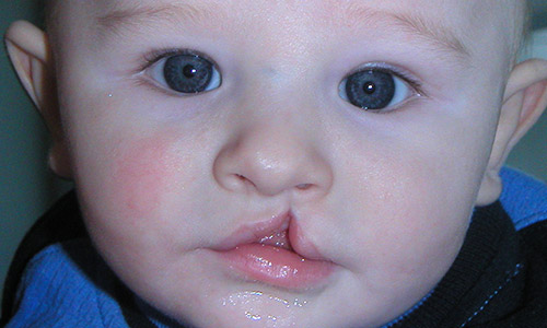 врожденное одностороннее расщепление верхней губы у ребенка