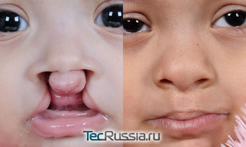 фото до и после пластики заячьей губы