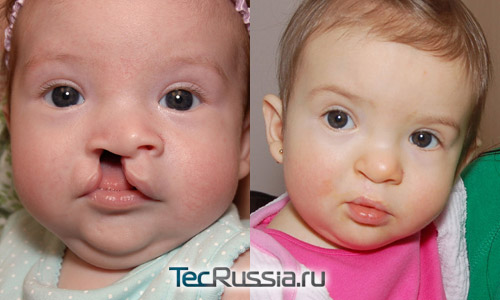 результаты коррекции расщепления губы у ребенка