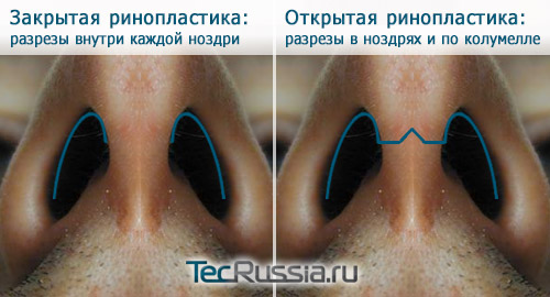 разница между способами проведения ринопластики