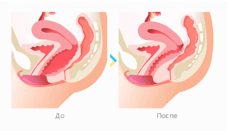 Уменьшение входа во влагалище