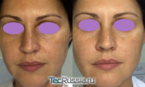 биоревитализация Skin – фото до и после
