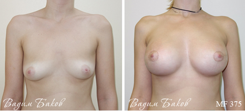 увеличение груди, фото до и после, вид спереди