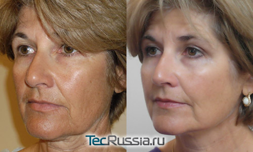 фото до и после биоармирования лица