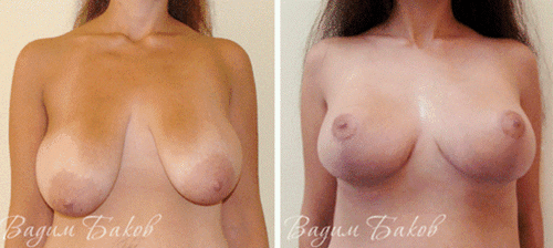 подтяжка груди – фото до и после, хирург В.С. Баков