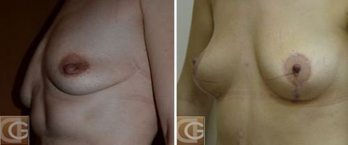 подяжка груди – фото до и после