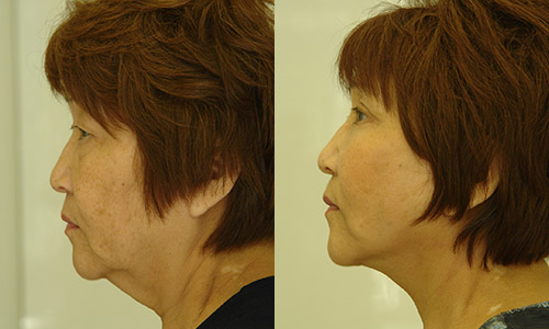 хирургическая подтяжка шеи – фото до и после