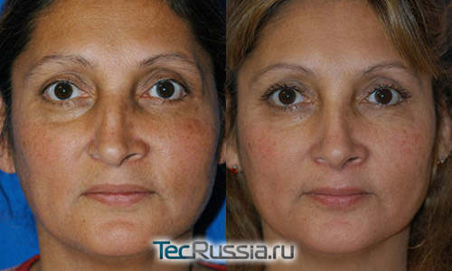 фото до и после ринопластики носа в результате перелома