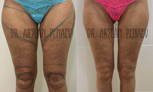 фото до и после васер-липосакции у доктора Пенаева
