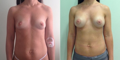 Фото до и после маммопластики у доктора Пшонкиной С.Ю.