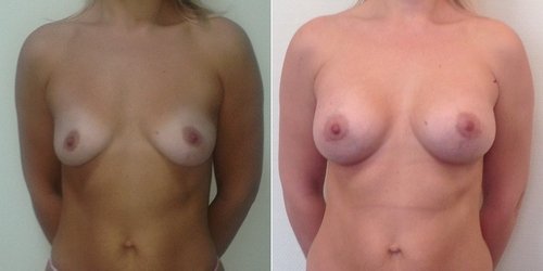 Фото до и после увеличения груди, хирург – Светлана Пшонкина