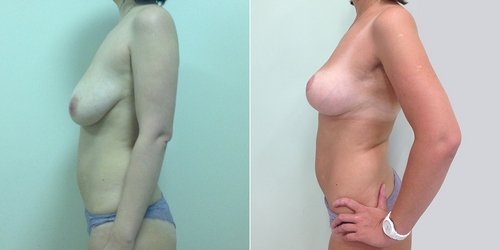Результаты операции по программе Ideal Breast у Светланы Пшонкиной