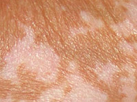 Белые пятна на коже: виды и способы лечения