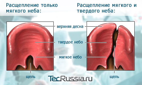 виды расщепления неба