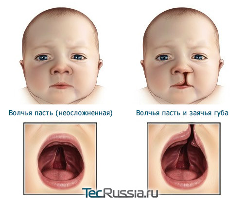 простая и осложненная волчья пасть