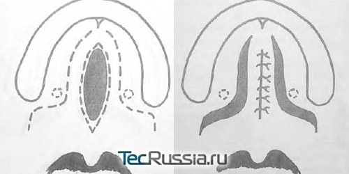 разрезы и швы при коррекции твердого неба