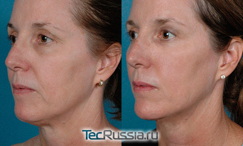 инфракрасный лазерный термолифтинг лица – фото до и после