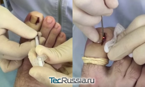 введение анестетика и лазерное удаление грануляционной ткани около вросшего ногтя